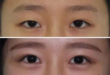 杭州駝峰鼻矯正哪家整形醫(yī)院技術(shù)獨(dú)特？2023杭州駝峰鼻矯正排名前10的醫(yī)院評(píng)測(cè)揭曉！