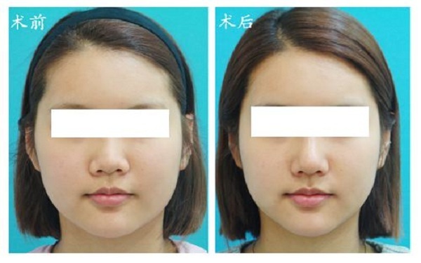 南陽哪家醫(yī)院注射鼻基底效果好？2023南陽玻尿酸注射鼻基底排行榜出爐！全城皆贊的十大醫(yī)院盤點！