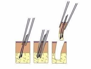 2023鄭州哪家整形醫(yī)院口碑好？眼角紋去除效果！