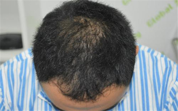 西安哪家醫(yī)院的小腿吸脂整形效果出眾？2023年排行榜前十名推薦！