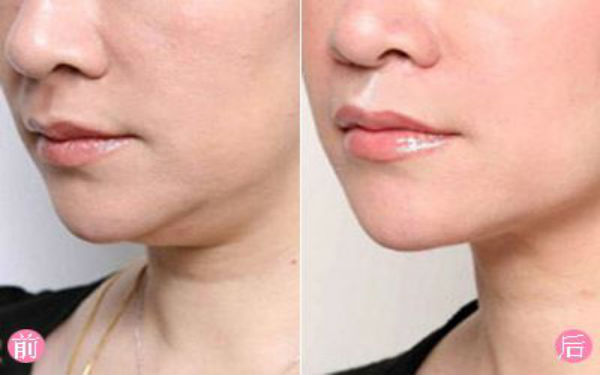 杭州消除額頭紋比較好的整形醫(yī)院排名公布，看看2023年前10位靠譜名單！