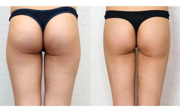 北京治療面部皺紋效果好的自體脂肪注射醫(yī)院哪家靠前？2023年北京自體脂肪注射面部皺紋醫(yī)療醫(yī)院TOP10排名榜