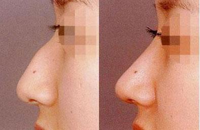 江陰溶脂針瘦背哪家整形美容醫(yī)院更受推薦？2023年江陰比較好的溶脂針瘦背醫(yī)院排行榜揭曉！前10強名單一覽！