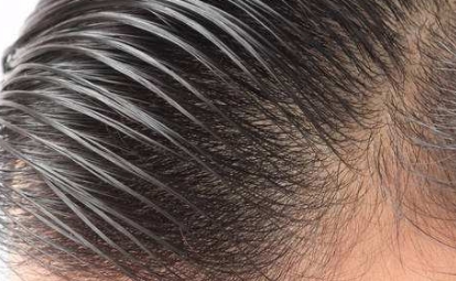 2023寧波領先的去額頭紋黃金微雕美容醫(yī)院推薦！