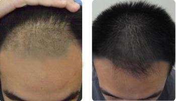 鎮(zhèn)江哪家醫(yī)院效果好？2023年玻尿酸填充額頭美容醫(yī)院排名全新預(yù)測！