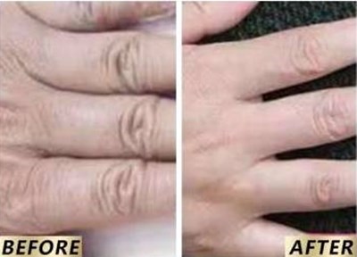 【2023非常受歡迎】南京高質(zhì)量魚(yú)尾紋激光去除醫(yī)院排行榜TOP10公布！看看有哪些值得去的！