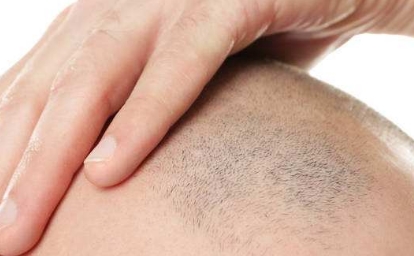 2023三亞微晶磨削點(diǎn)痣醫(yī)療美容醫(yī)院推薦，求穩(wěn)定效果好的！