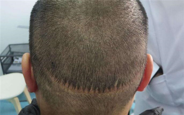 重慶十家熱門醫(yī)院推薦！2023重慶超聲去除黑眼圈美容醫(yī)院精選十強深度評判！