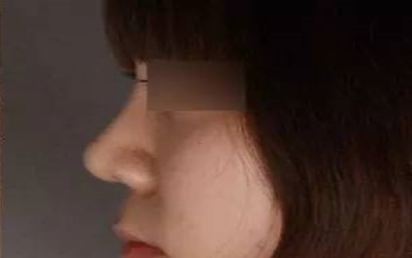 重慶哪家整形醫(yī)院祛黑眼圈效果靠譜？2023年重慶祛黑眼圈醫(yī)療機(jī)構(gòu)排名前十值得信賴嗎？