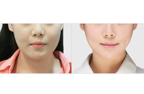 2023杭州祛生長紋醫(yī)院排行榜公布！這些整形專家經(jīng)驗(yàn)豐富的醫(yī)院排名前十！