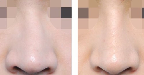 湖南哪家醫(yī)院比較好做光乳化手術(shù)祛眼袋？湖南2023年全國十佳整形醫(yī)院眼袋療效！推薦！