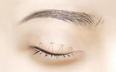 2023年武漢專業(yè)祛川字紋醫(yī)院排行榜出爐，TOP10強(qiáng)名單公布！