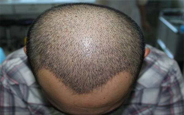 無錫哪家醫(yī)院的假體太陽穴整形效果比較好？2023年排名前10位的醫(yī)院值得選擇！