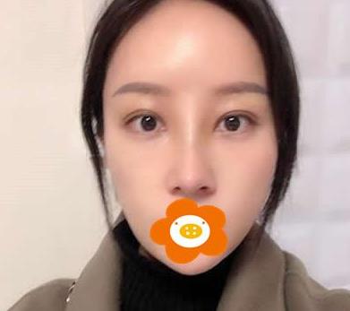 鄭州禾麗做肋軟骨隆鼻術(shù)后兩個(gè)月效果 鄭州禾麗做肋軟骨隆鼻術(shù)后兩個(gè)月效果