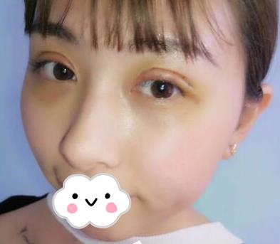 武漢亞太整形雙眼皮案例術后三天效果