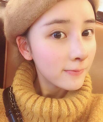 北京藝星整形硅膠假體隆鼻術(shù)后兩個月效果 北京藝星整形硅膠假體隆鼻術(shù)后兩個月效果