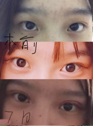 做雙眼皮案例，濟南坤如瑪麗崔金珍雙眼皮案例圖片