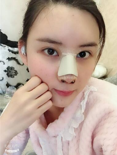 北京藝星整形硅膠假體隆鼻術(shù)后第二天正面效果 北京藝星整形硅膠假體隆鼻術(shù)后第二天正面效果