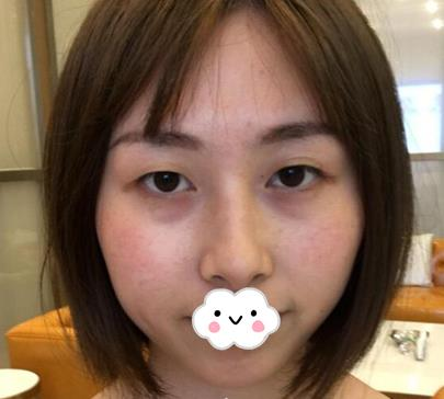 武漢亞太整形雙眼皮術后一個月效果分享