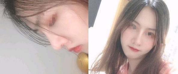 濱州醫(yī)學(xué)院附屬醫(yī)院做隆鼻三個月效果 濱州醫(yī)學(xué)院附屬醫(yī)院做隆鼻三個月效果