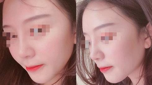 耳軟骨隆鼻術(shù)后三個月，我有了韓佳人同款美鼻