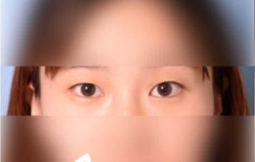 延吉金光善整形雙眼皮一個月效果分享，有對比圖