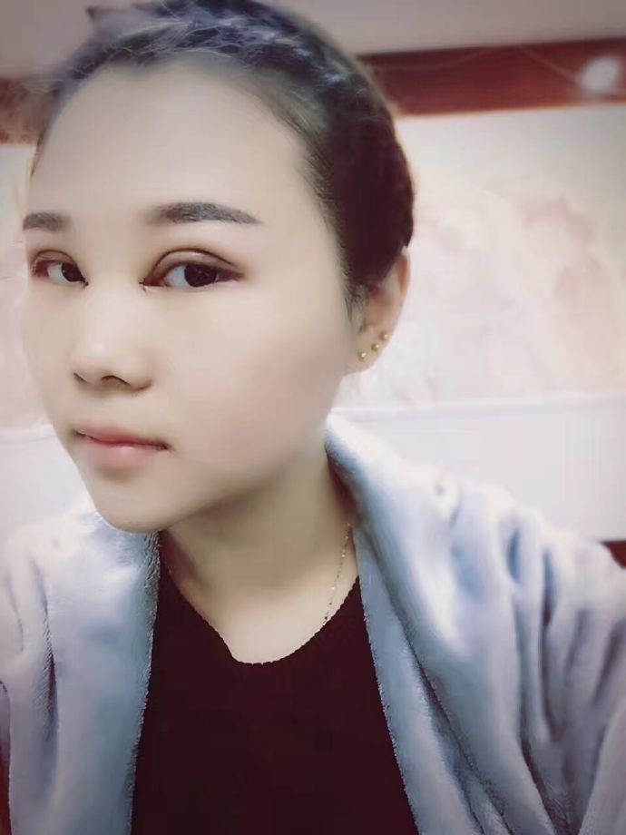 汕頭曙光雙眼皮一周側(cè)面效果