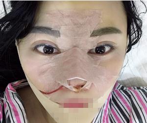 重慶星范整形超體隆鼻術(shù)后兩天效果