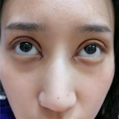 雙眼皮失敗丑的不敢見人，昆明麗都整形雙眼皮修復案例分享