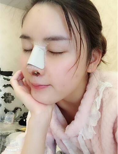 北京藝星整形硅膠假體隆鼻術(shù)后第二天側(cè)面效果 北京藝星整形硅膠假體隆鼻術(shù)后第二天側(cè)面效果