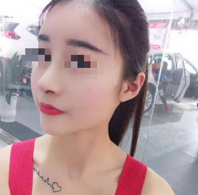 石家莊諾萬(wàn)整形姚華榮硅膠隆鼻案例分享術(shù)前效果后三個(gè)月效果 石家莊諾萬(wàn)整形姚華榮硅膠隆鼻案例分享術(shù)前效果后三個(gè)月效果