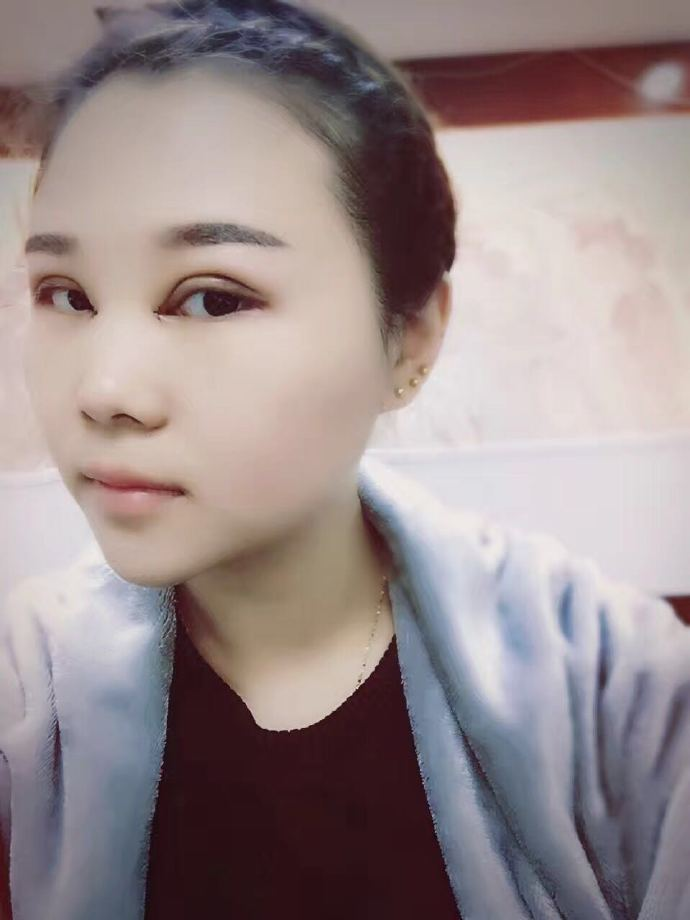 腫眼泡應(yīng)該做哪種雙眼皮？汕頭曙光雙眼皮三個(gè)月效果分享