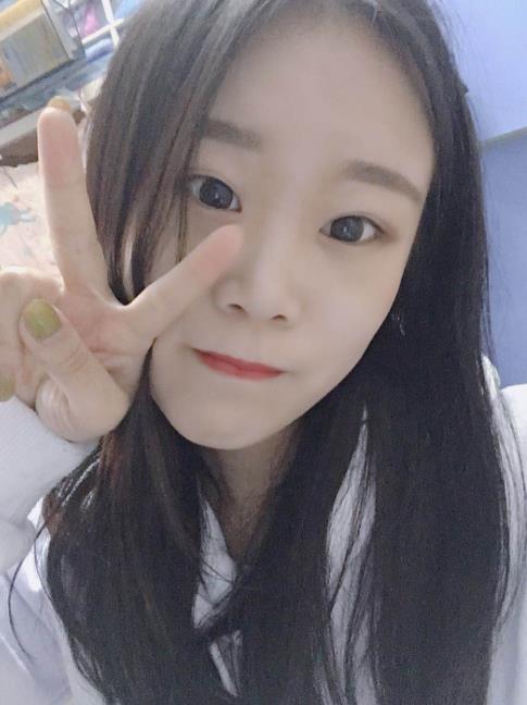 石家莊諾萬整形肋軟骨隆鼻案例術(shù)后一個月效果