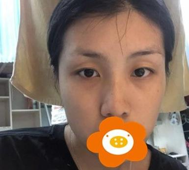 救命，周杰群做的耳軟骨隆鼻恢復(fù)后鼻背線條也太好看了吧