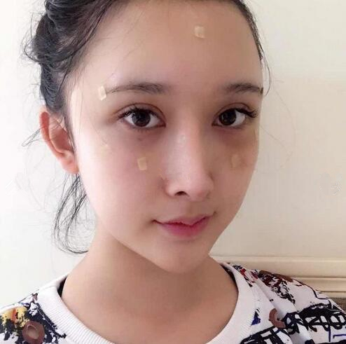 深圳陽光全臉填充術(shù)后即刻效果