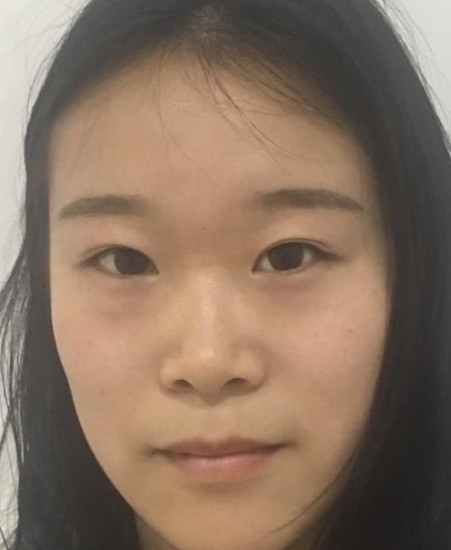 石家莊諾萬整形肋軟骨隆鼻案例術(shù)前效果