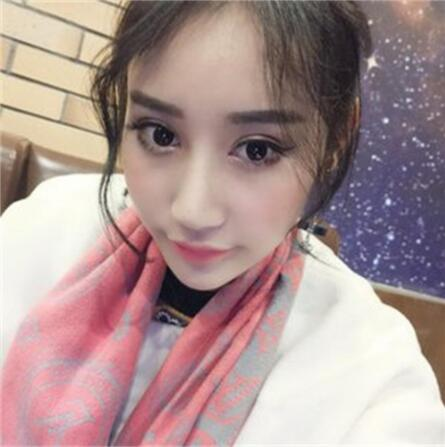 雙眼皮失敗丑的不敢見人，昆明麗都整形雙眼皮修復案例分享