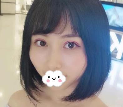 武漢亞太整形雙眼皮案例術后兩個月效果