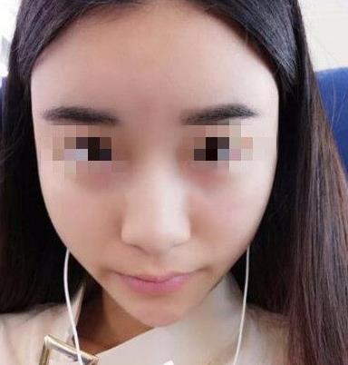 石家莊諾萬(wàn)整形姚華榮硅膠隆鼻案例分享術(shù)前效果 石家莊諾萬(wàn)整形姚華榮硅膠隆鼻案例分享術(shù)前效果