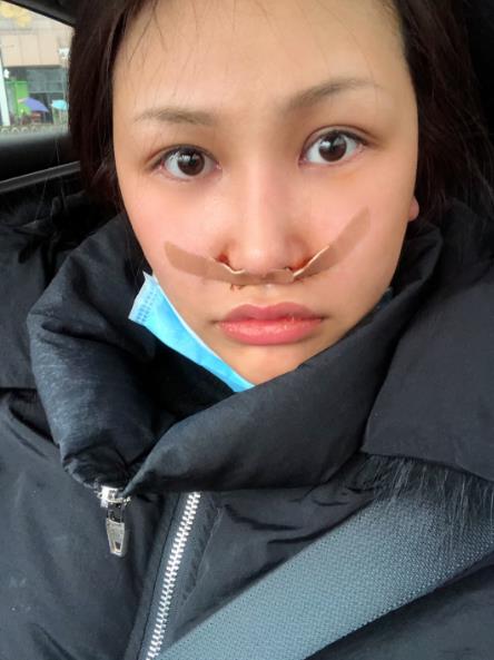 長春中研整形黃帝云鼻頭縮小案例術(shù)后第二天