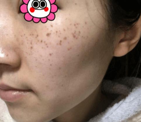 溫州韓美整形激光祛斑案例術(shù)前效果 溫州韓美整形激光祛斑案例術(shù)前效果