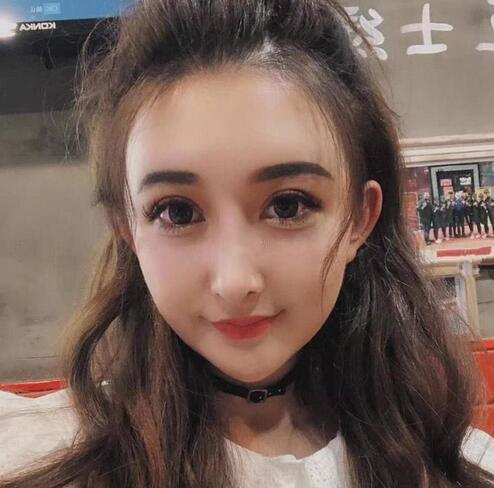 深圳陽光全臉填充術前術后對比，說年輕十歲不過分吧