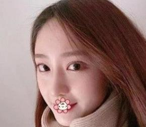 北京彤美耳軟骨隆鼻三個月效果分享，吐血推薦