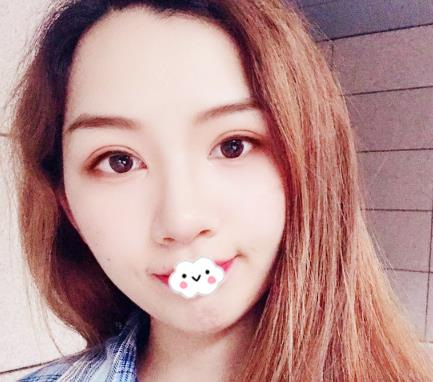 武漢伊萊美割雙眼皮怎么樣？切開雙眼皮恢復(fù)過程圖