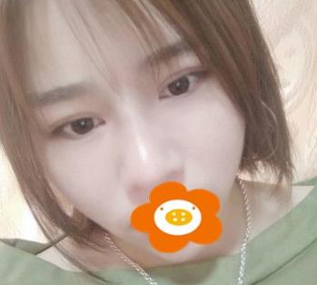 杭州薇琳隆鼻術(shù)后三個月效果 杭州薇琳隆鼻術(shù)后三個月效果