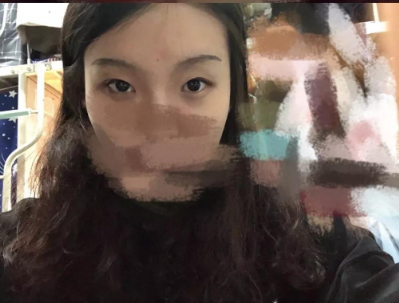 做雙眼皮案例，北京藝星張順慶雙眼皮案例圖片