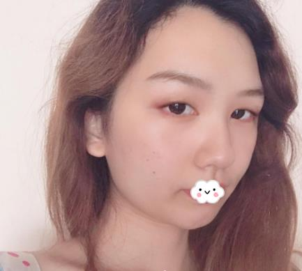 武漢伊萊美割雙眼皮怎么樣？切開雙眼皮恢復(fù)過程圖