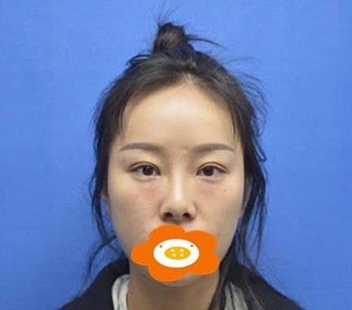 鄭州禾麗做肋軟骨隆鼻術(shù)前效果 鄭州禾麗做肋軟骨隆鼻術(shù)前效果