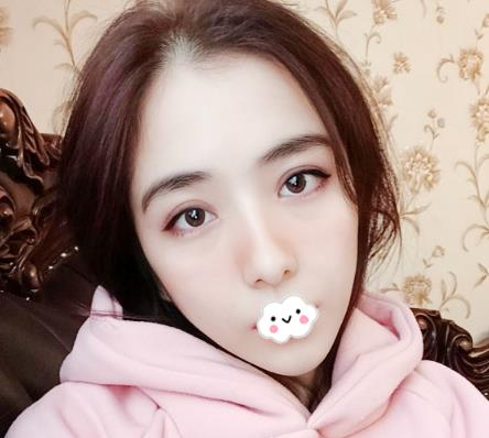 大連沙醫(yī)生整形付德林做的自體軟骨隆鼻效果，給大家做個參考