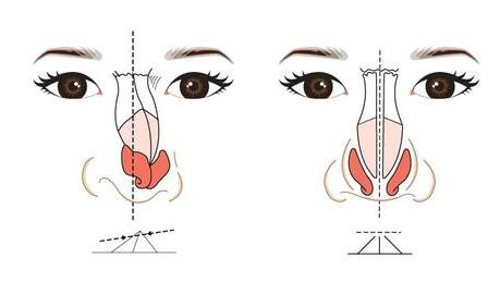 天津時光整形歪鼻矯正 天津時光整形歪鼻矯正